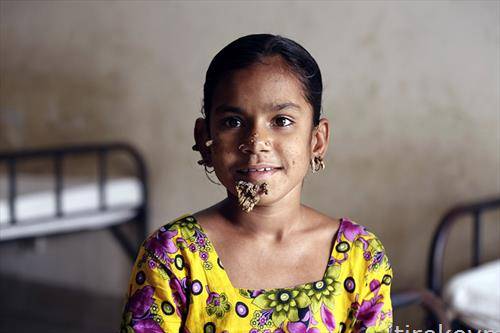 лекарски преглед поради симптоми на синдром  човек-дрво во Дака, Бангладеш